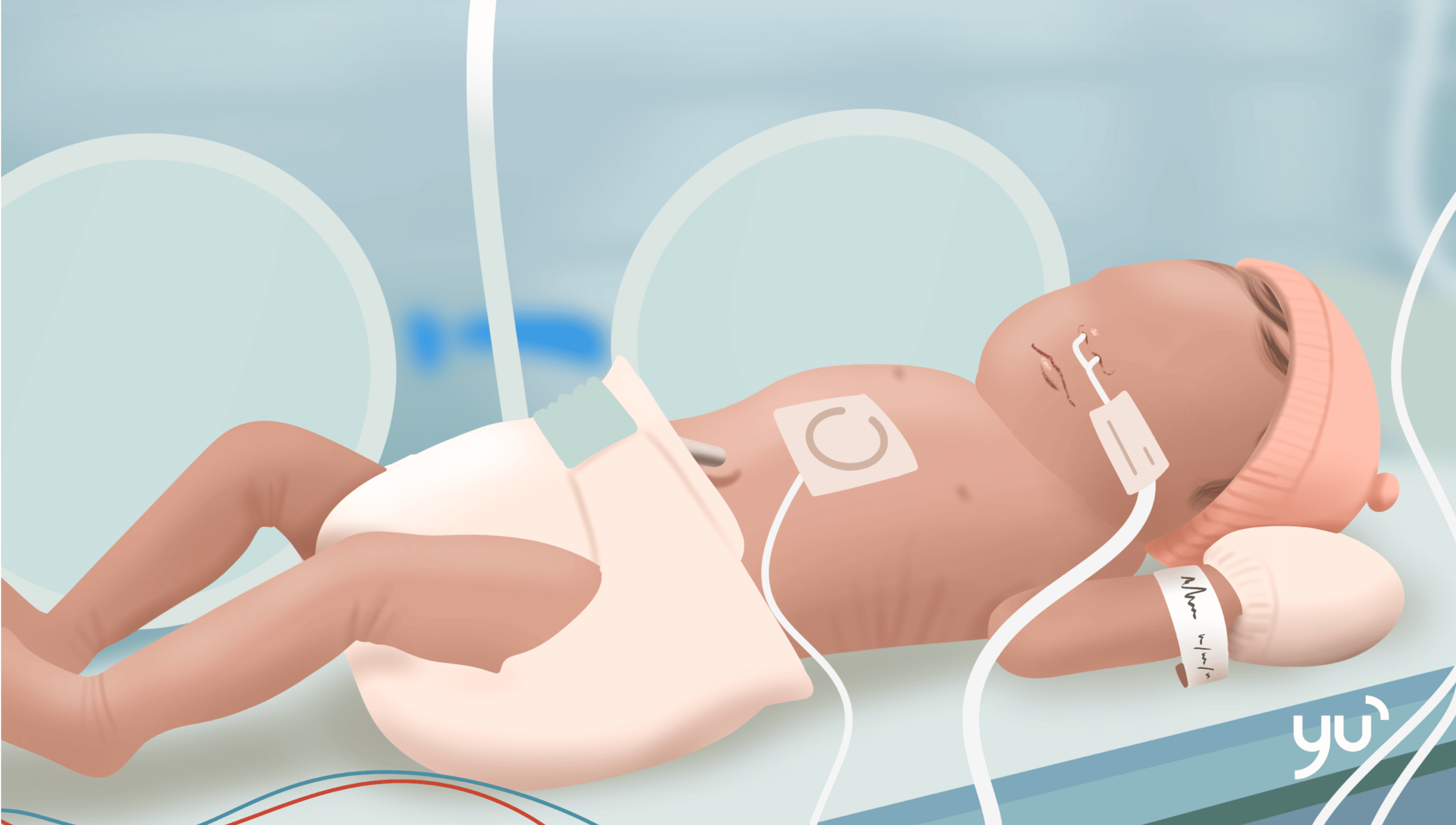 Bébés prématurés : que savoir