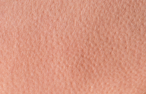 Nettoyage des pores pour l’acné sévère : conseils essentiels