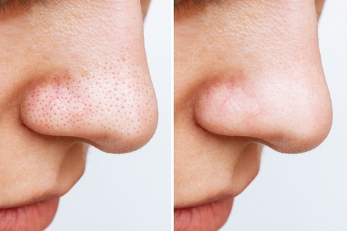 Comment réduire les pores dilatés pour une peau parfaite ?