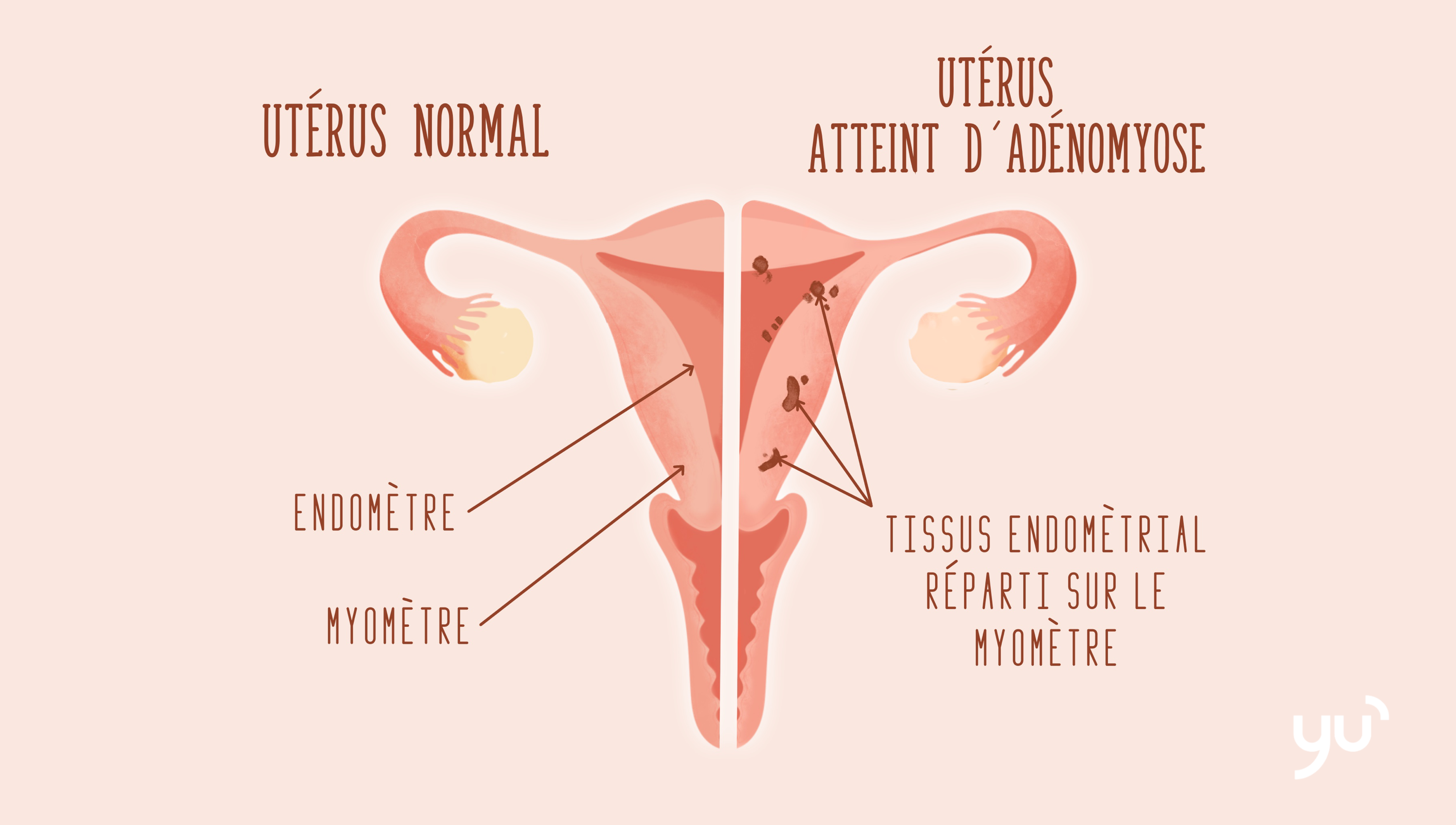 L’adénomyose : une maladie gynécologique méconnue