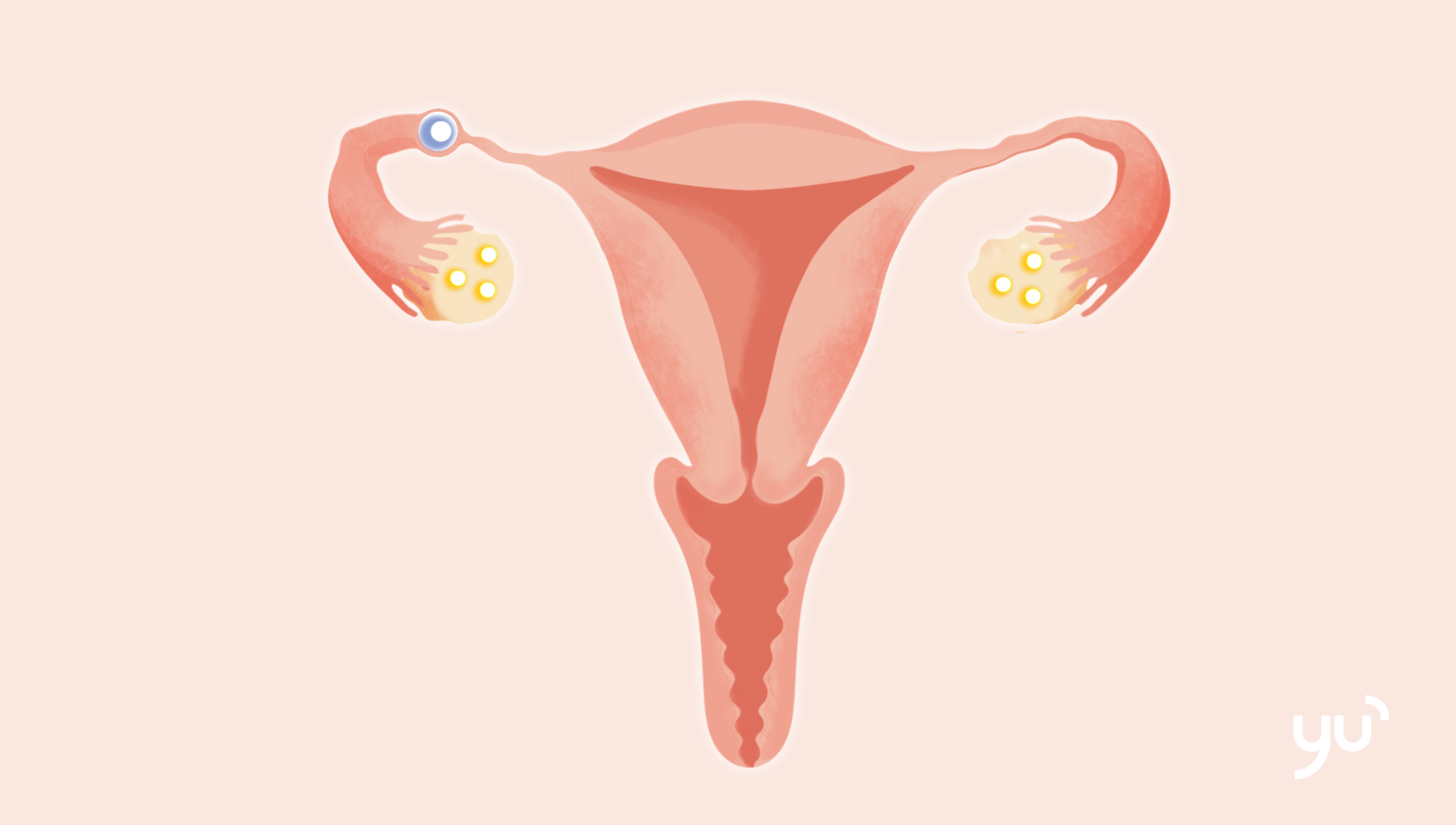 Tout savoir sur la grossesse extra-utérine