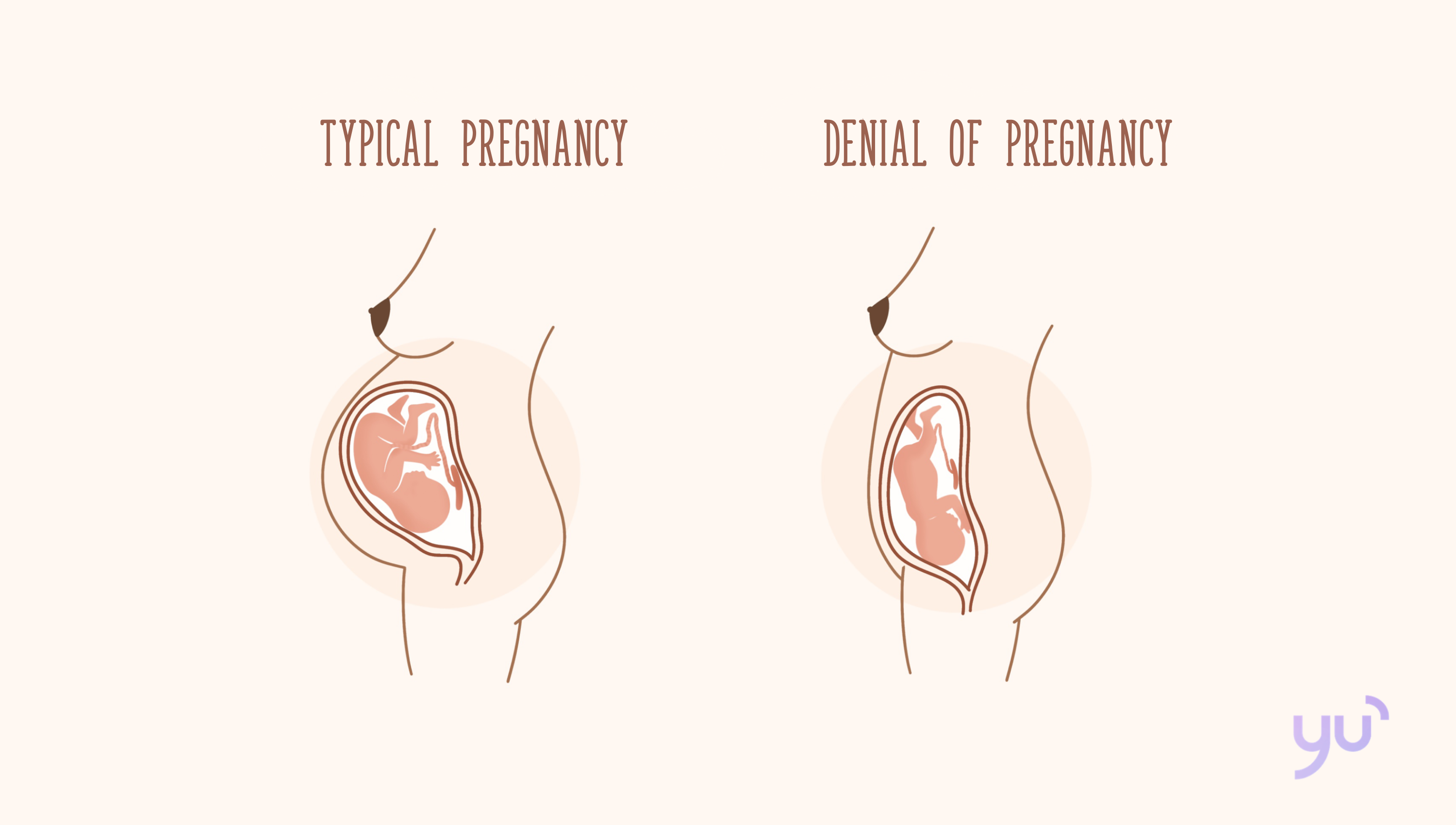 Comprendre le déni de grossesse