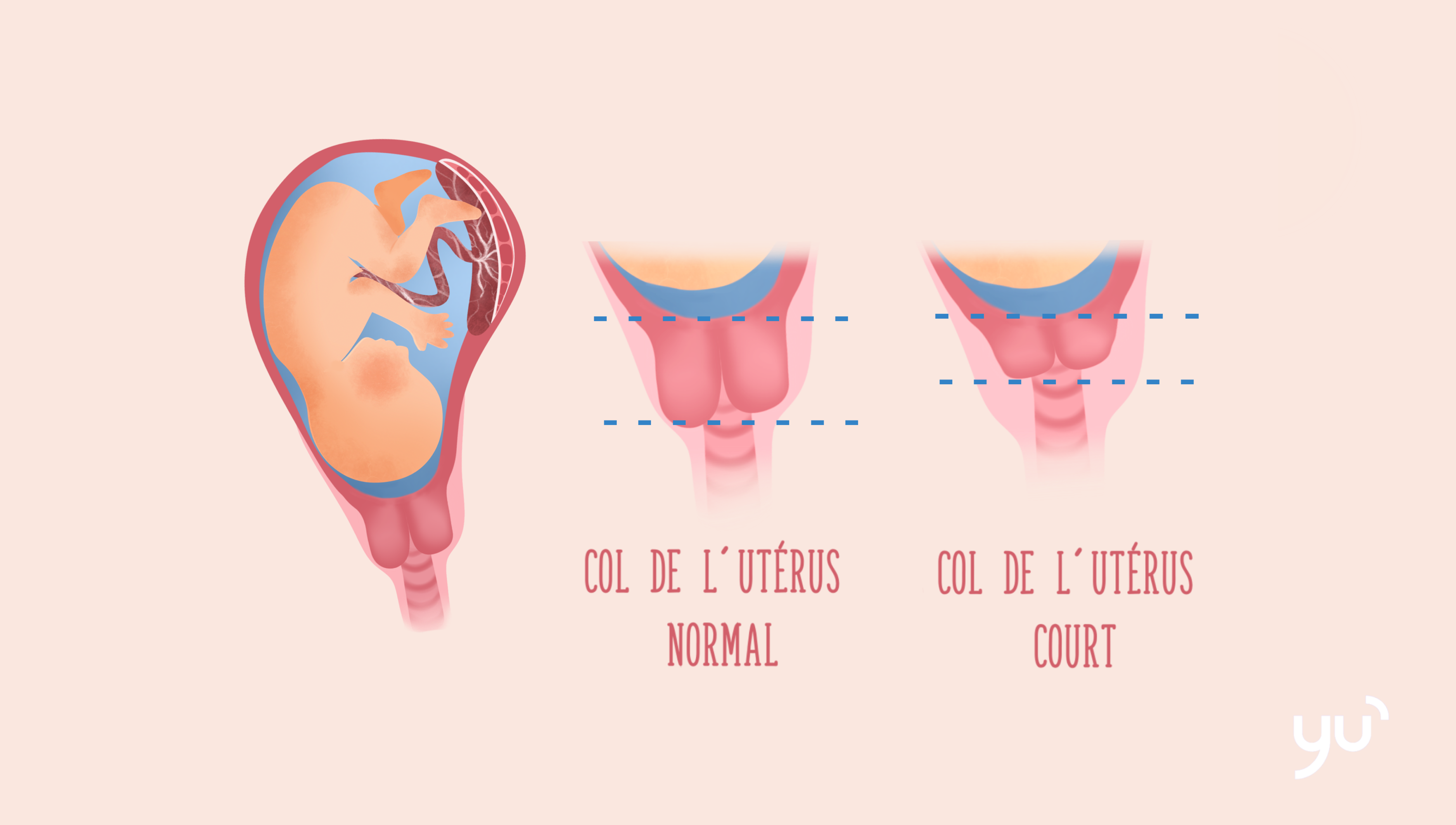Grossesse à risque : comprendre le col de l’utérus court
