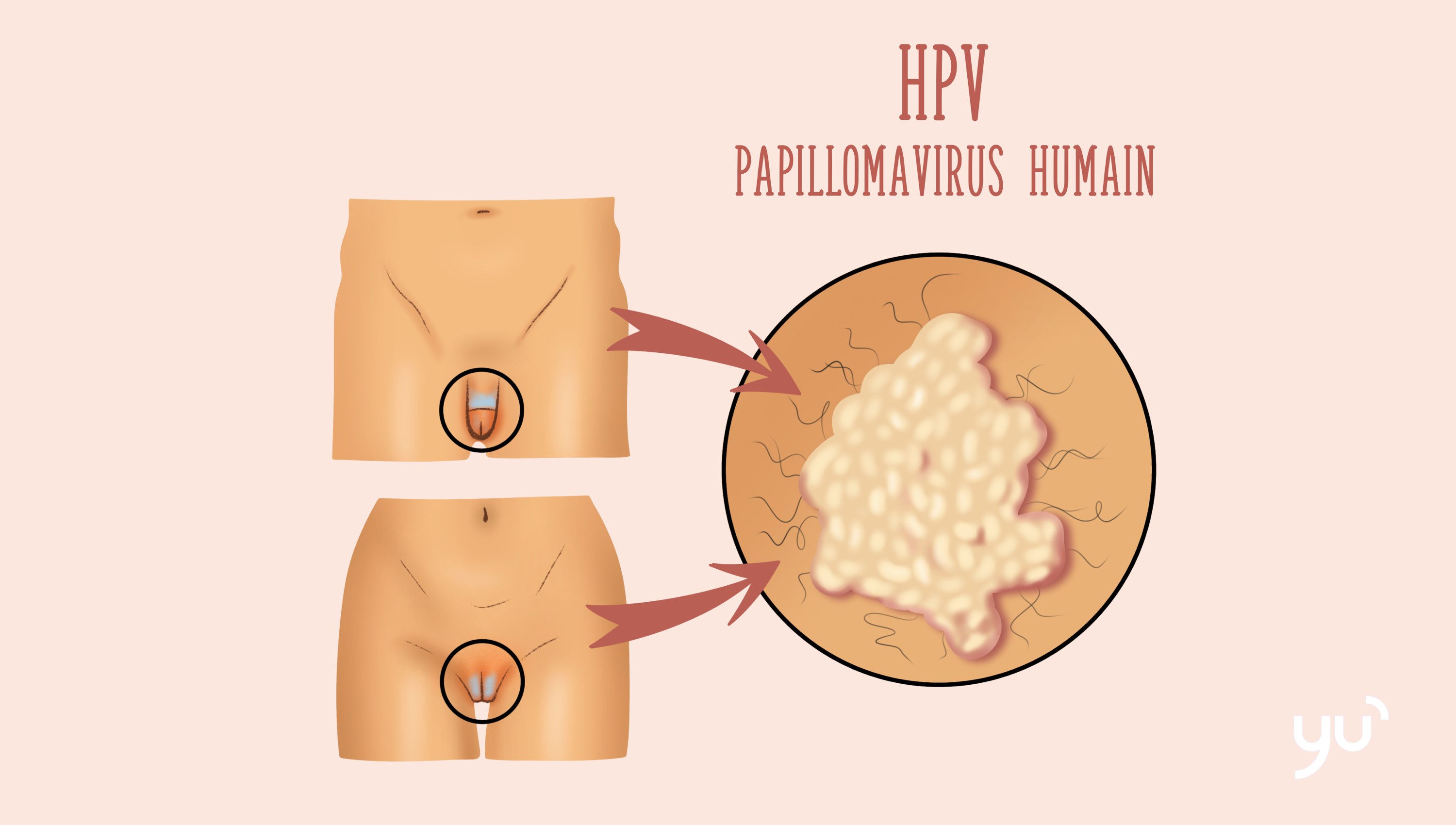 Les condylomes : tout ce que vous devez savoir
