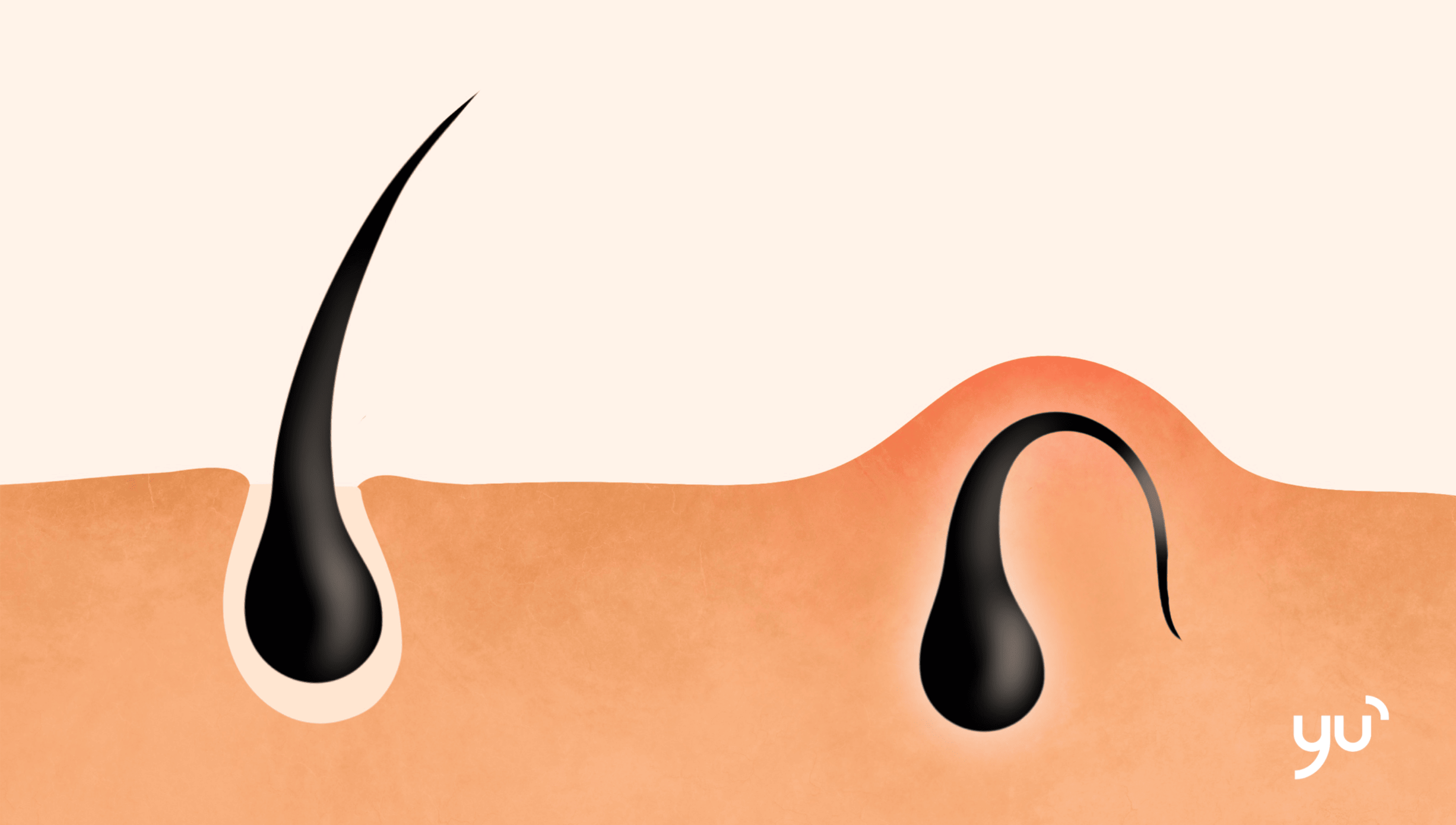 Poils incarnés : causes, prévention et traitements