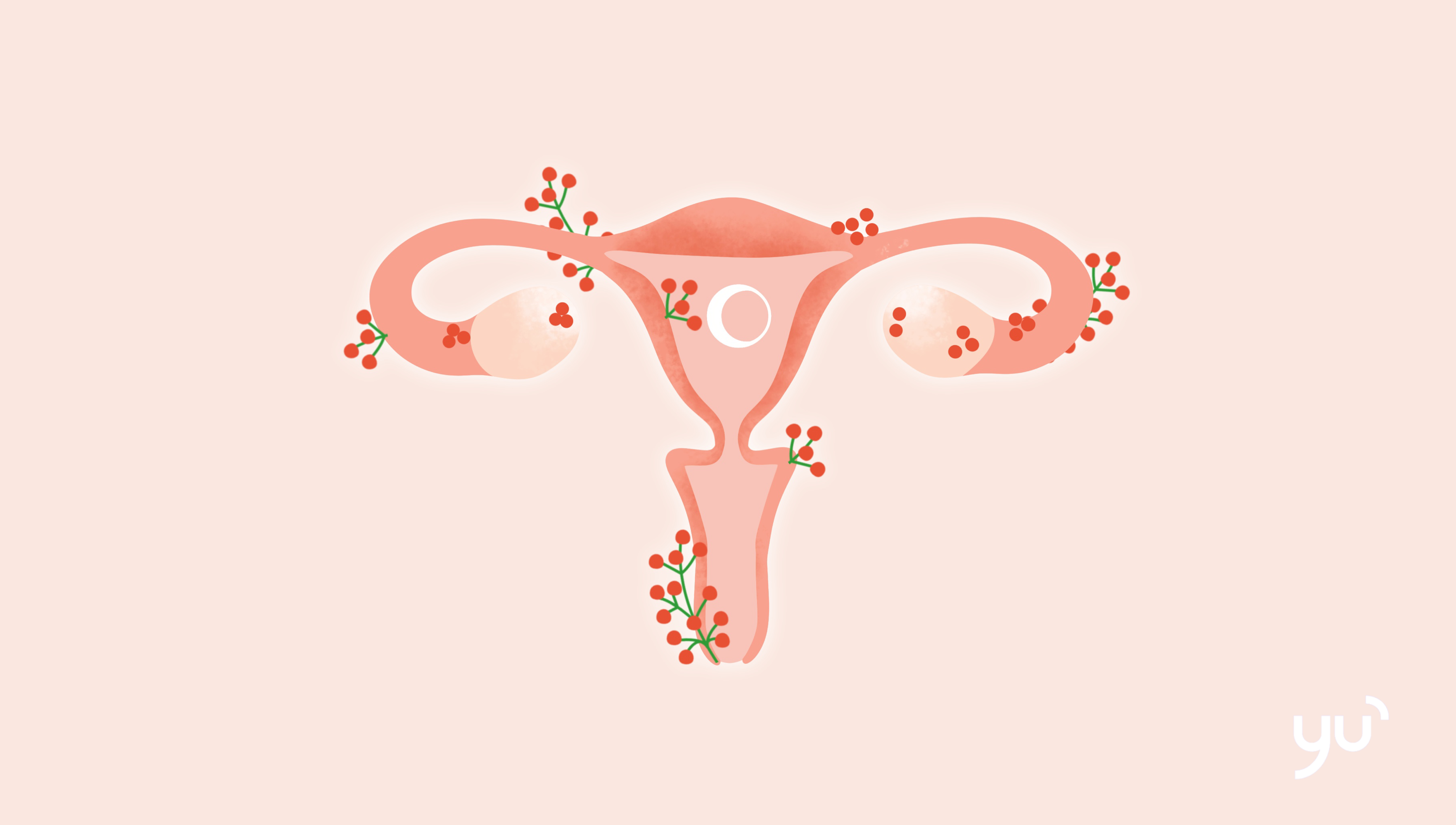 L’endométriose : qu’est-ce que c’est exactement ?