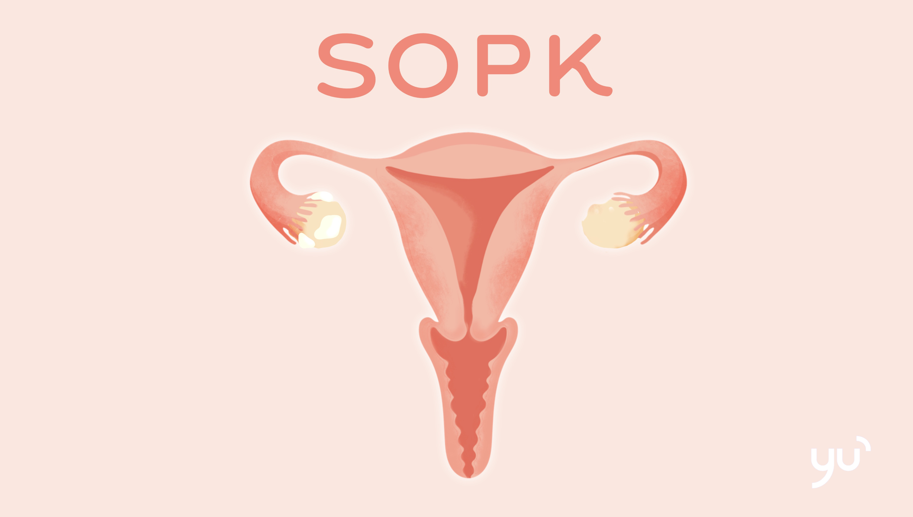 Comprendre le Syndrome des Ovaires Polykystiques : symptômes, causes et traitements