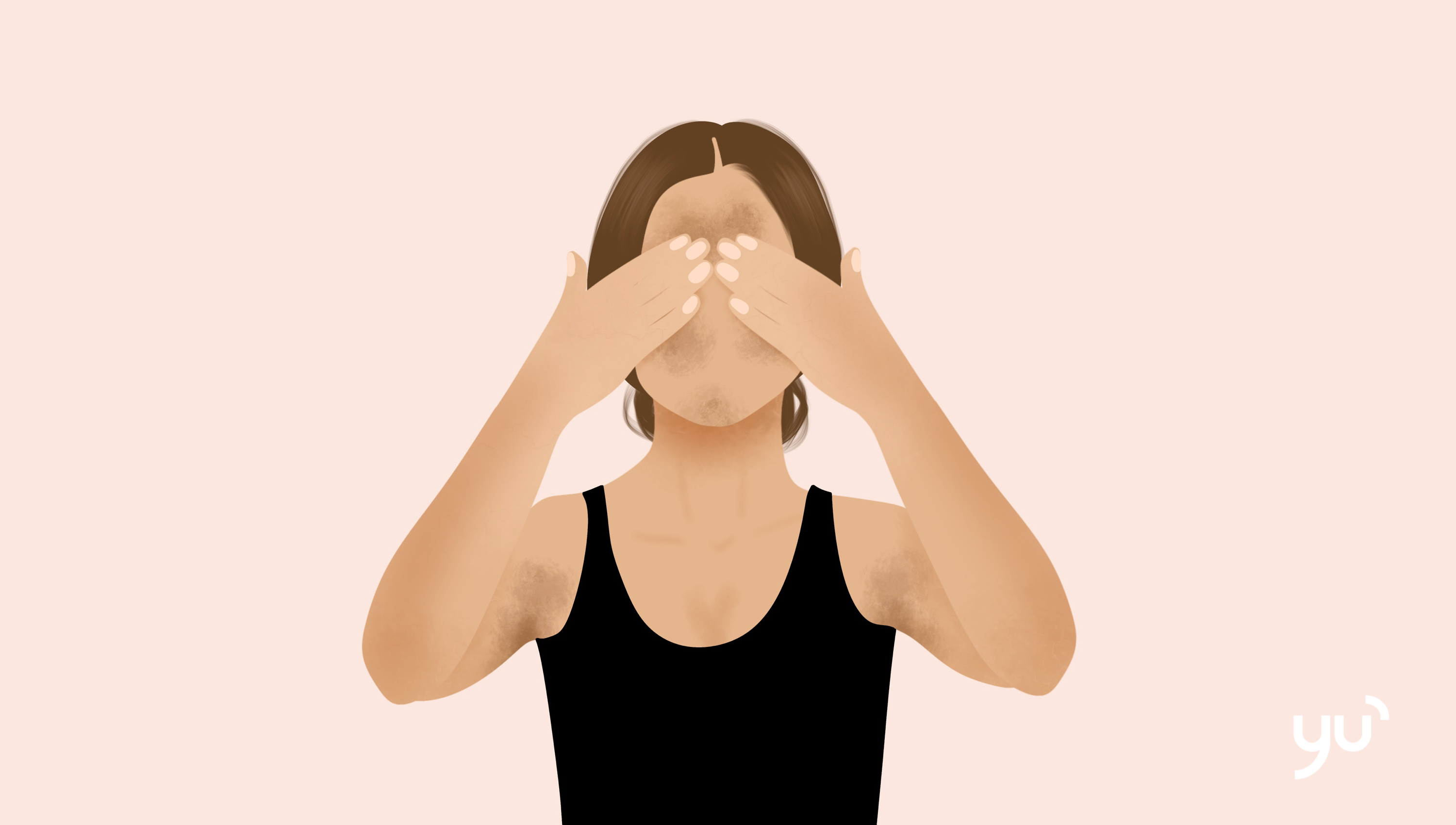 Hyperpigmentation et SOPK : comprendre les liens et les manifestations cutanées