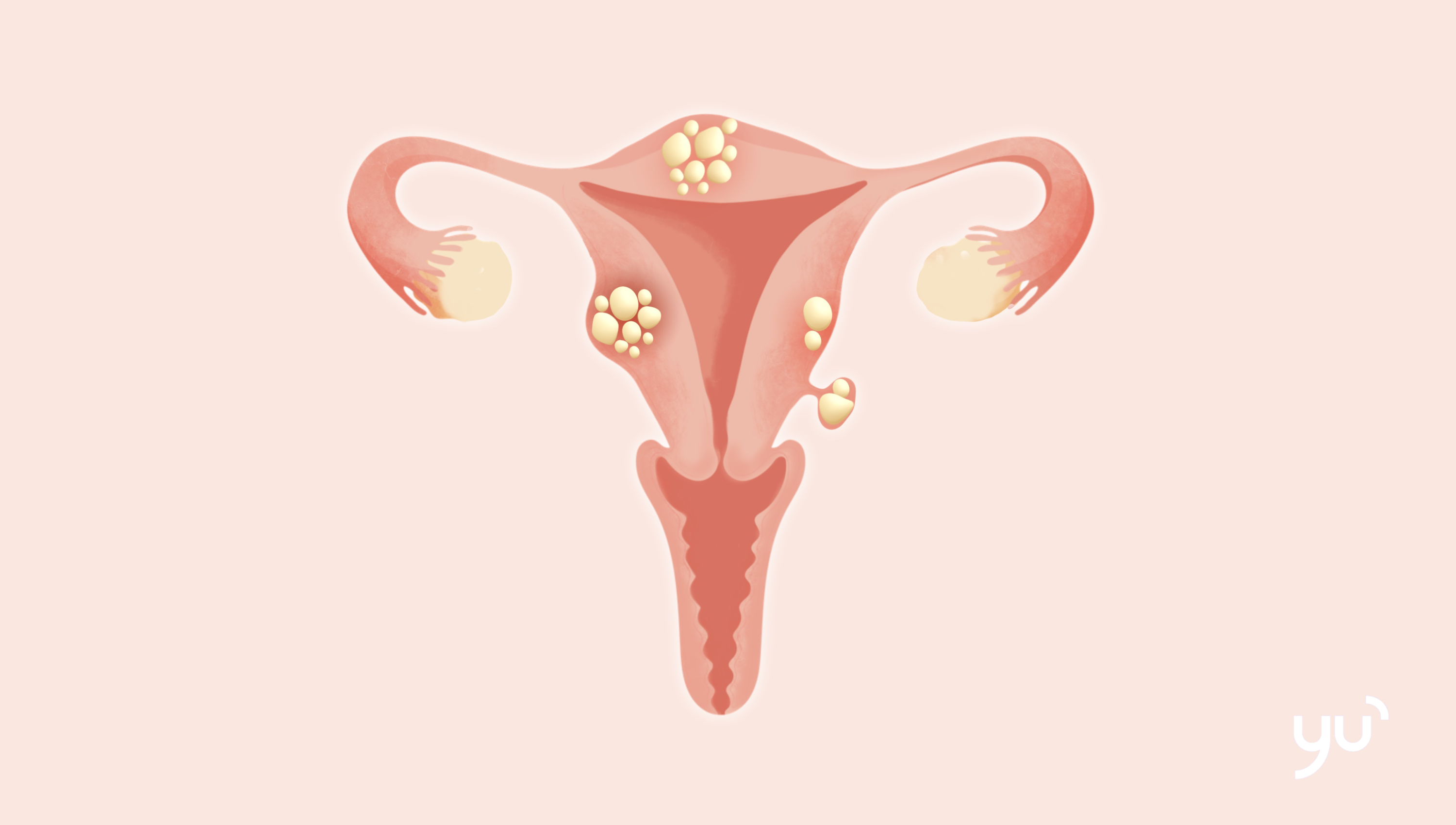 Fibromes utérins : tout ce que vous devez savoir