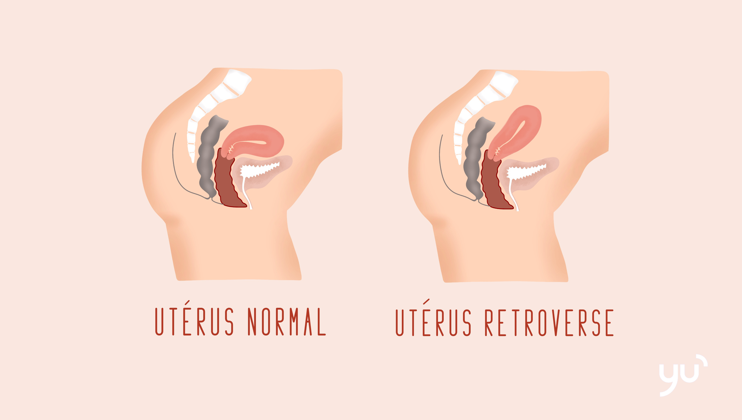 L’utérus rétroversé : un phénomène qui concerne 25% des femmes