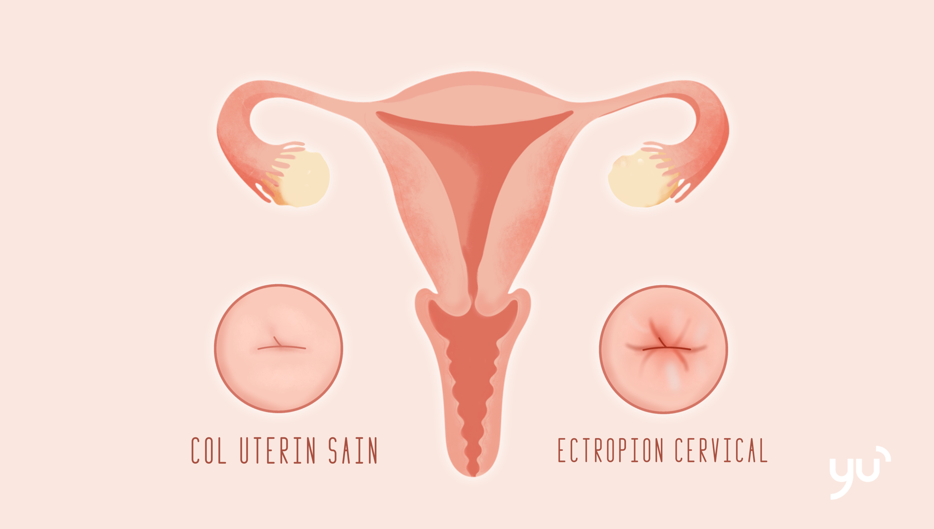 L’ectropion cervical : ce que vous devez savoir