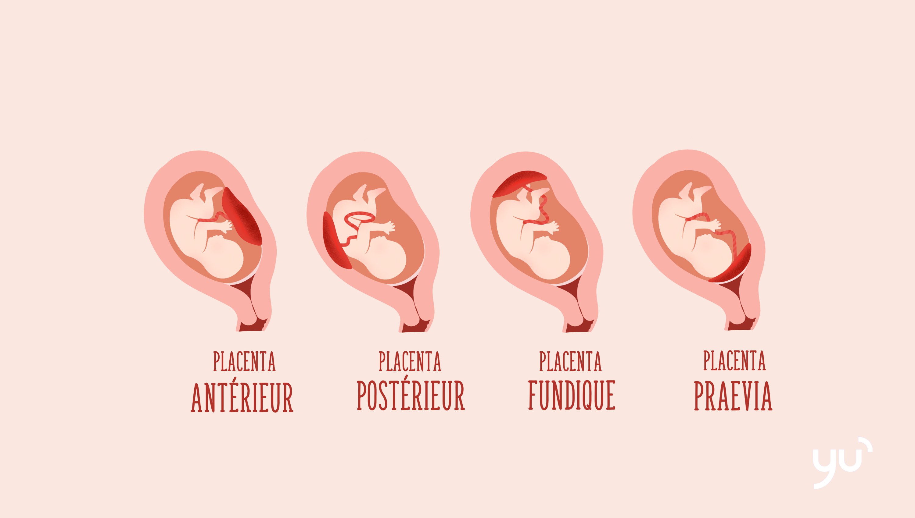 Que signifie un placenta fundique ?