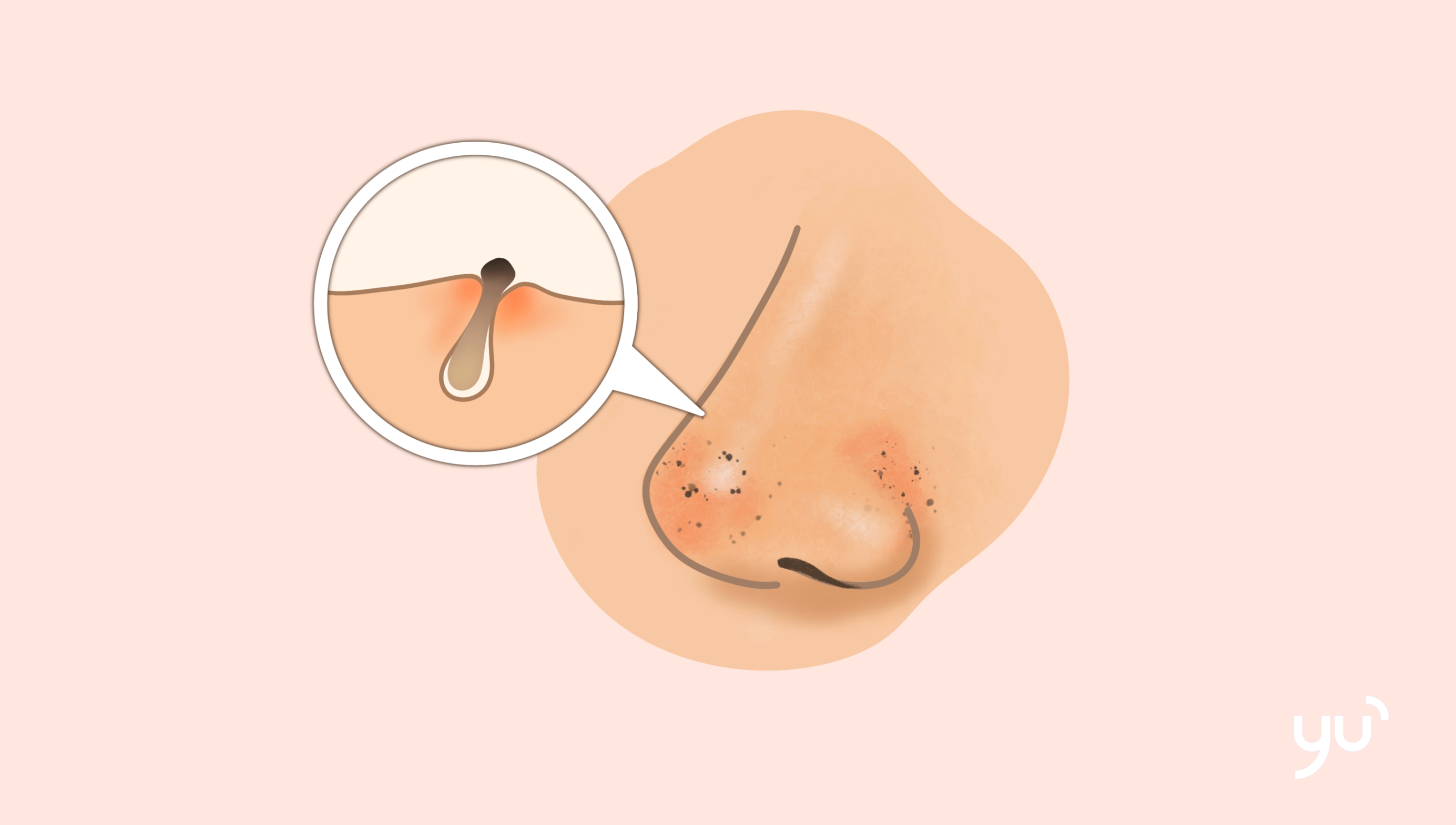 Décryptage des lésions acnéiques : points noirs, points blancs et plus encore